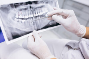 radiografía de mandíbula - eordental